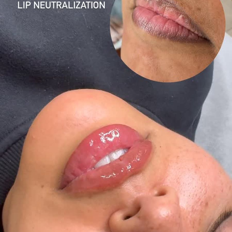 Healed lip neutralization