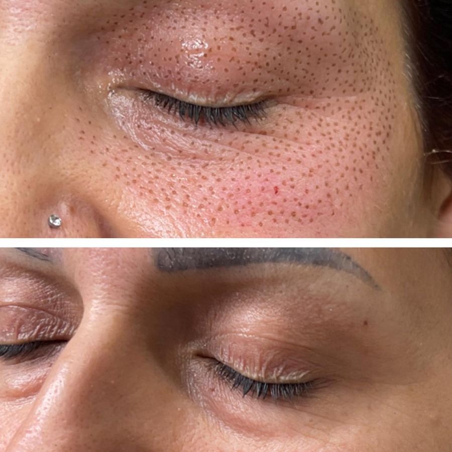 Before and after fibroblast skin tightening