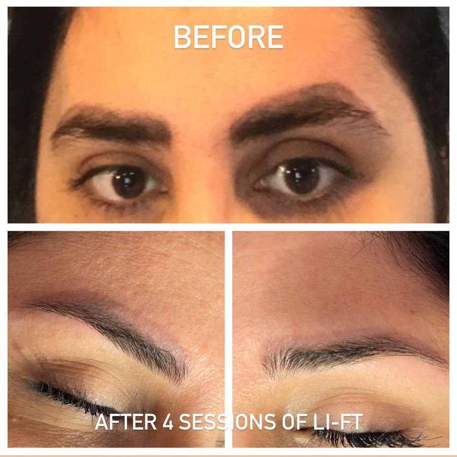Before and after 4 sessions of permanent makeup removal